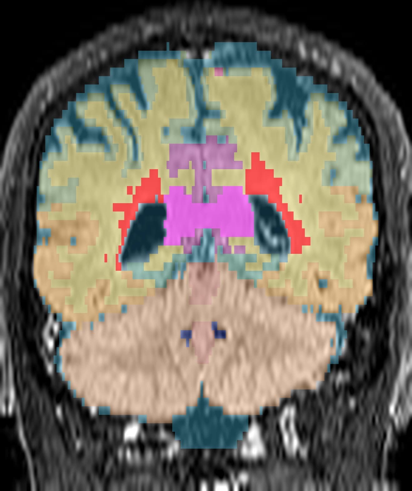 The same slice after MindGlide has read it: each brain region is shaded a different colour — grey matter, white matter, cerebellum, corpus callosum and the ventricles — and the multiple sclerosis lesions are picked out in red beside the lateral ventricles.