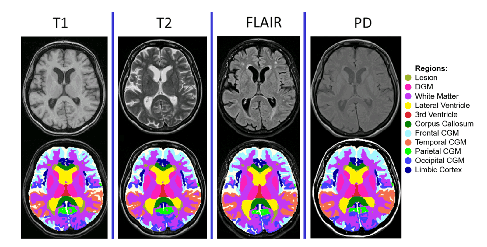 MindGlide output: brain MRI slices with automatically delineated lesions and tissue boundaries