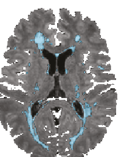 Axial brain MRI slice with multiple sclerosis lesions highlighted in blue