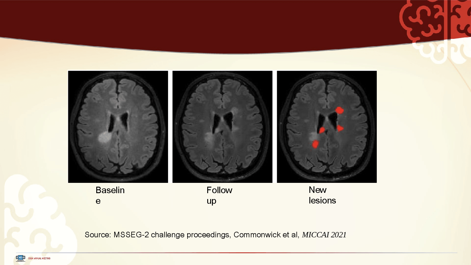Slide 15: Source: MSSEG-2 challenge proceedings, Commonwick et al, MICCAI 2021