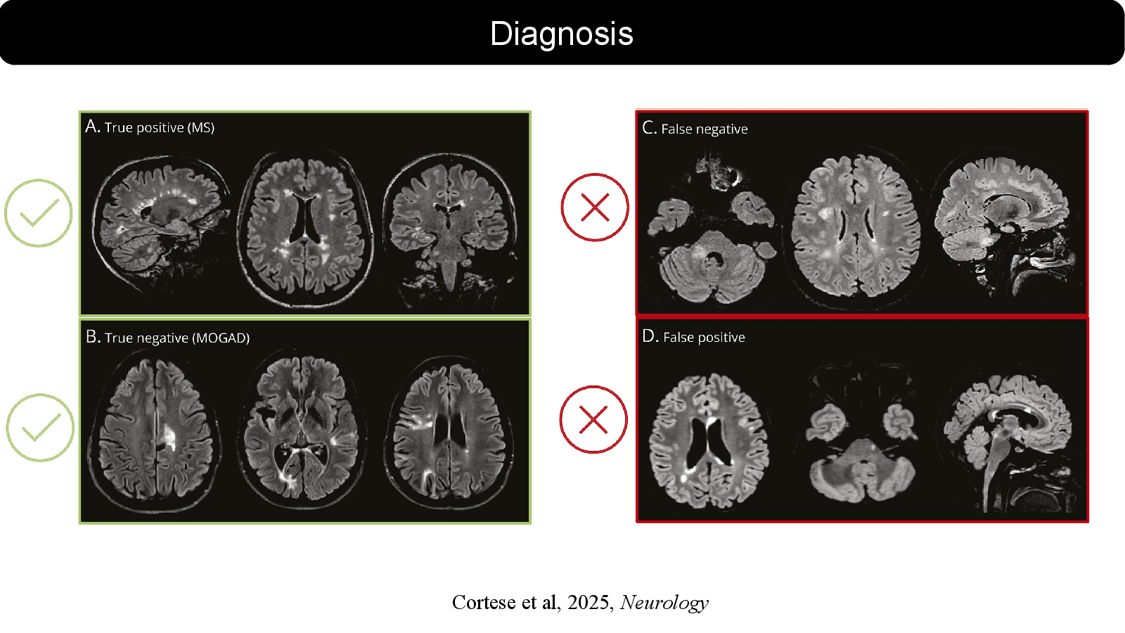 Slide 16: Cortese et al, 2025, Neurology