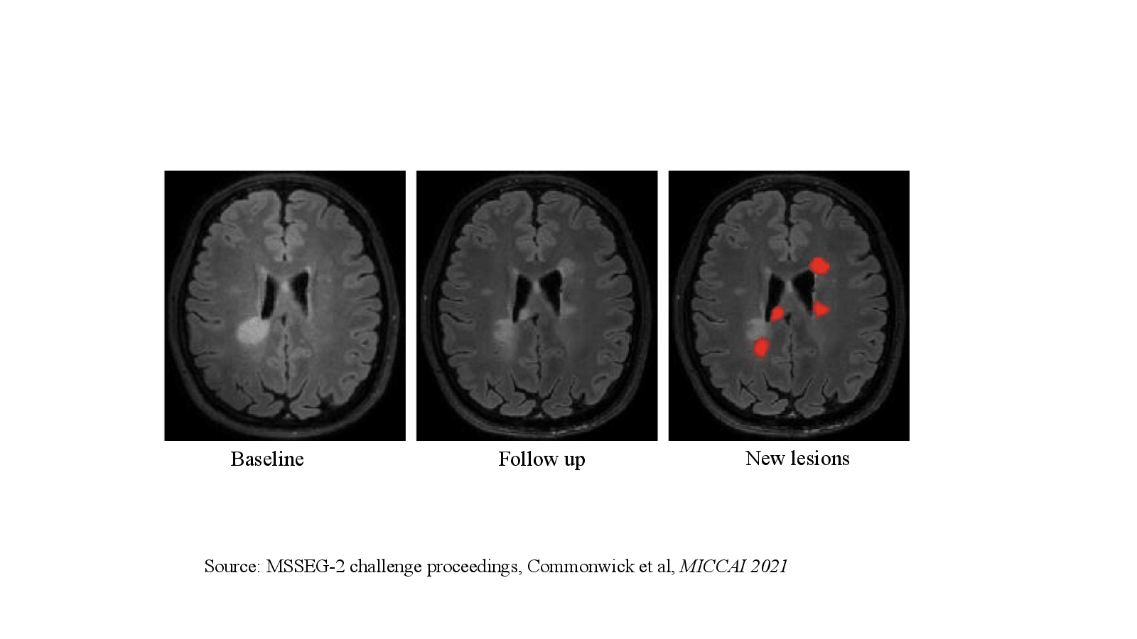 Slide 6: Source: MSSEG-2 challenge proceedings, Commonwick et al, MICCAI 2021