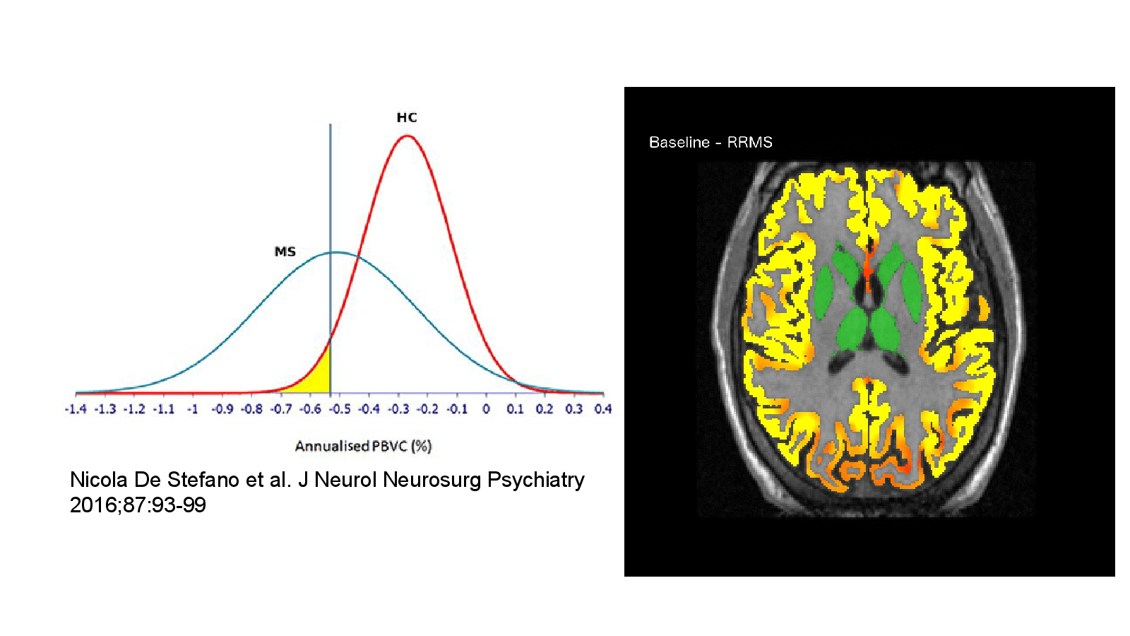 Slide 13: Nicola De Stefano et al. J Neurol Neurosurg Psychiatry 2016;87:93-99