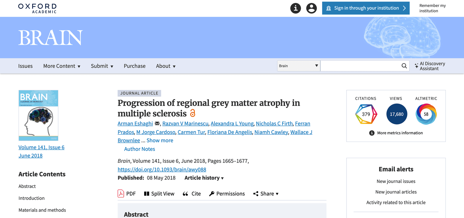 Mapping the order in which brain regions shrink in multiple sclerosis