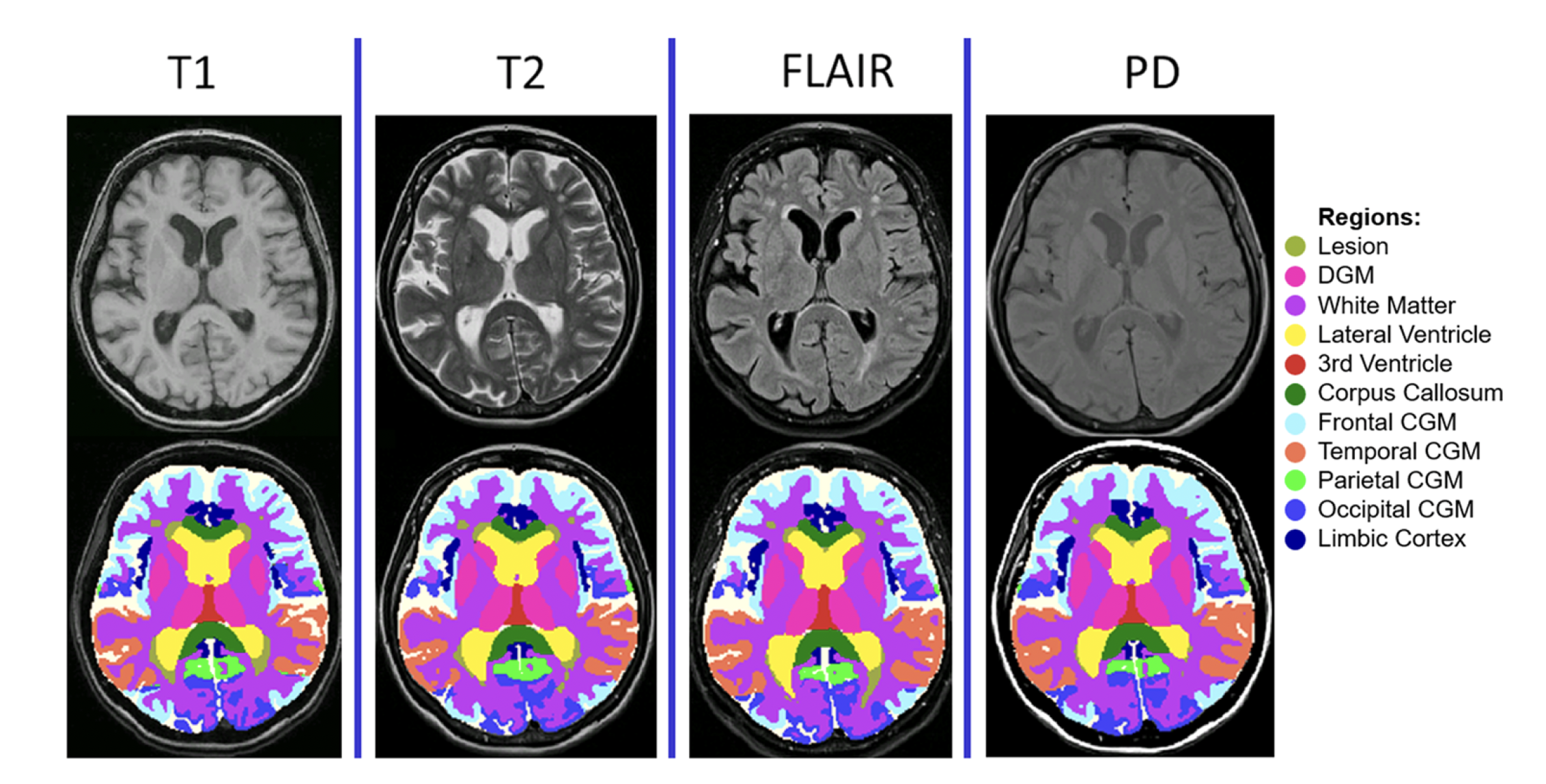 MindGlide unlocks routine MRI archives to accelerate MS research