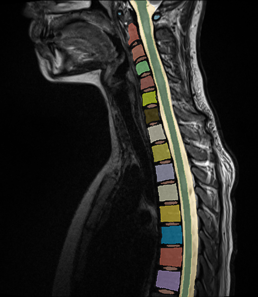 Barbara Brito Vega to present spinal cord MRI research at MSToronto2026