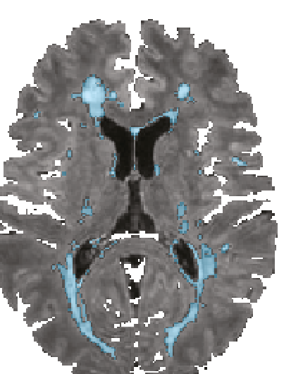 Axial brain MRI slice with multiple sclerosis lesions highlighted in blue